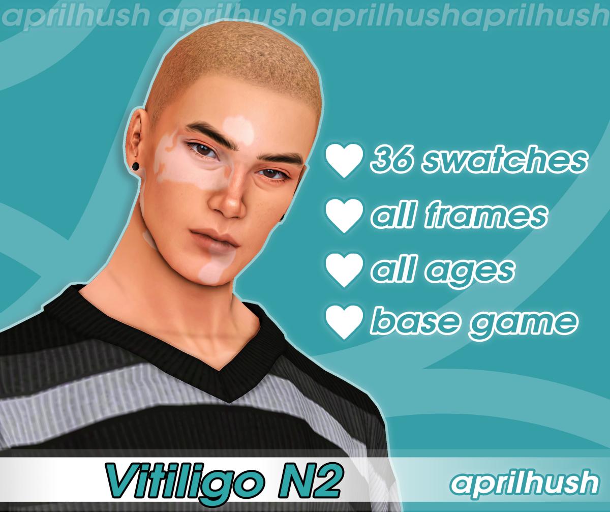 Витилиго "Vitiligo N2"